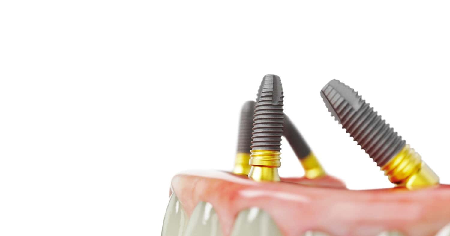 All_on_4_TiUltr - Kopie (5)