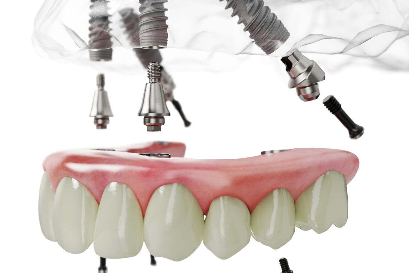 All_on_4_TiUnit - Kopie (3)